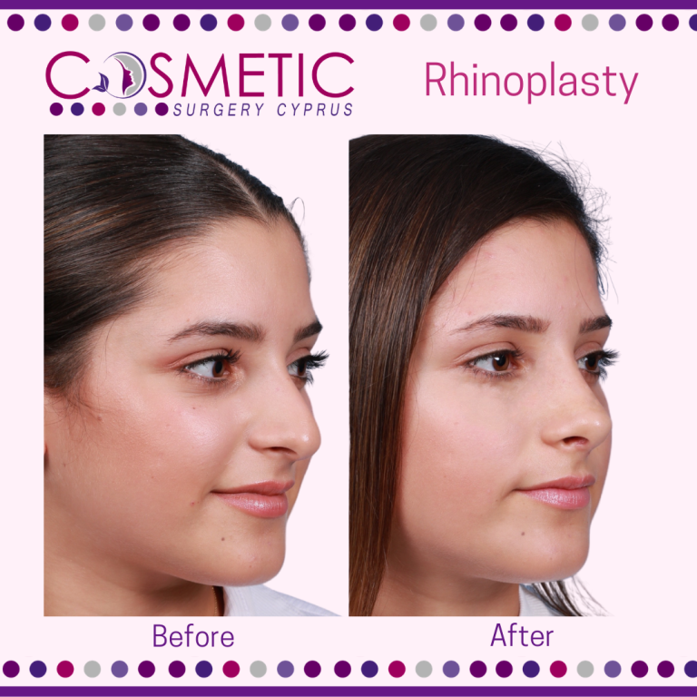 Ultrasonic Rhinoplasty Abroad Benefits - Cosmetic Surgery Abroad