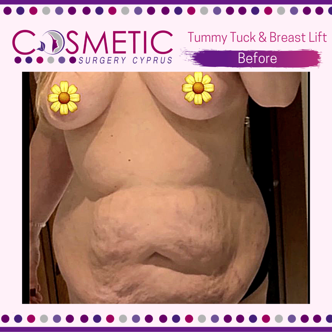 BREAST LIFT  Cosmetic Plastic Surgery Abroad