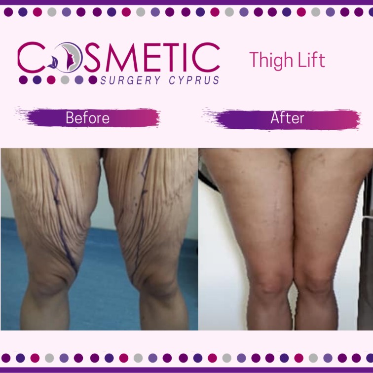 Thigh Lift Abroad - Inner Thigh Lift Surgery in Tunisia
